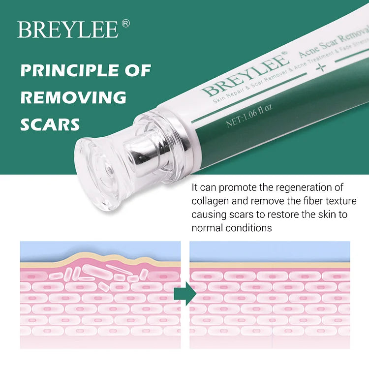 Scar removal cream skin care Acne Scar Removal Cream