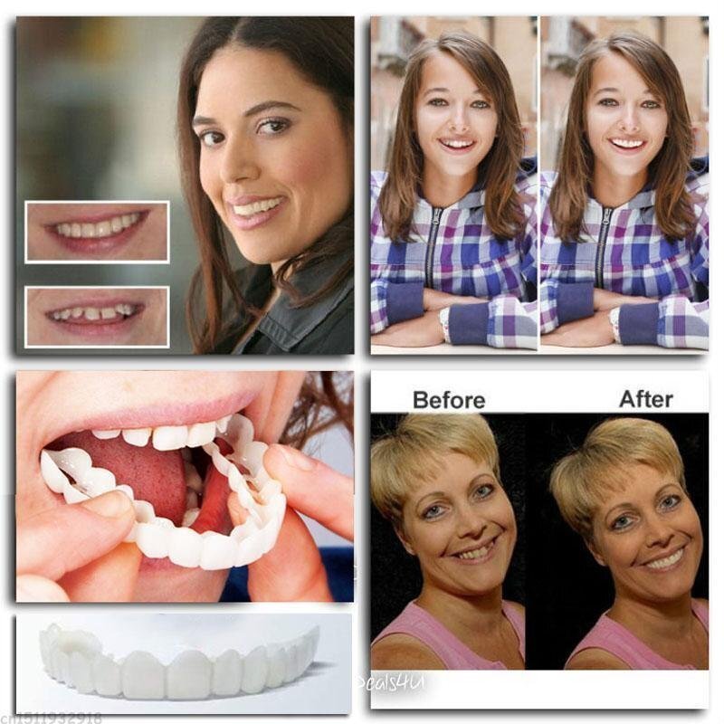 Adjustable Snap-On Dentures【Can eatting+General size】【The only genuine store!】